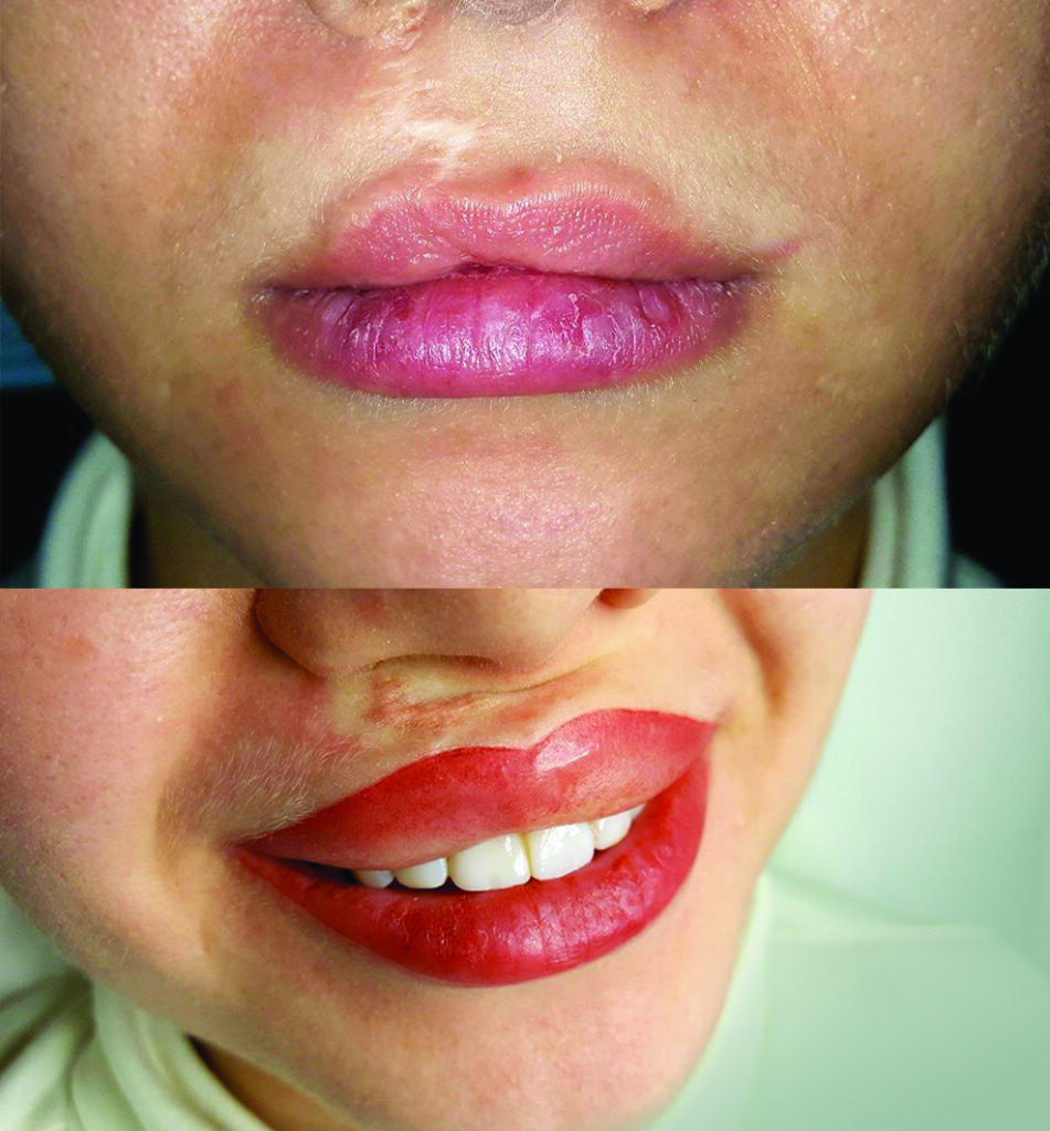 Mikropigmentacja medyczna, makijaż permanentny medyczny